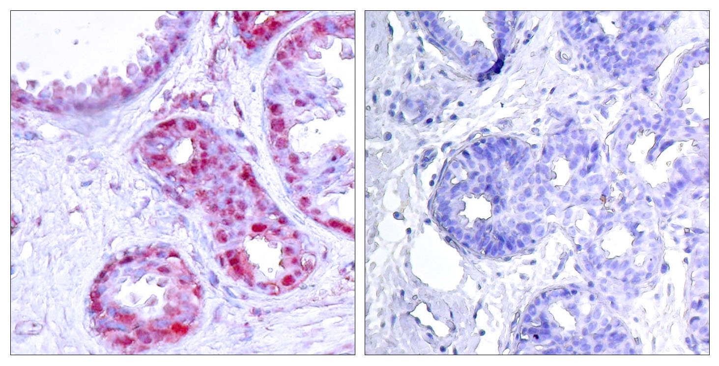 Immunohistochemical analysis of paraffin-embedded human breast carcinoma tissue using c-Jun (Phospho-Ser243) Antibody  (left) or the same antibody preincubated with blocking peptide (right).
