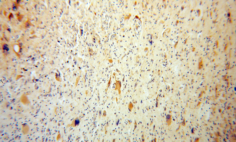 Immunohistochemical of paraffin-embedded human gliomas using Catalog No:108059(ANGPTL5 antibody) at dilution of 1:100 (under 10x lens)