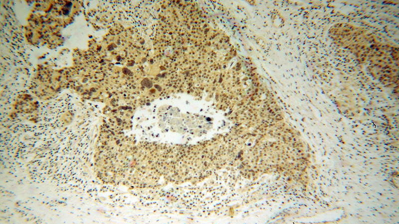 Immunohistochemical of paraffin-embedded human ovary tumor using Catalog No:113432(OSBPL2 antibody) at dilution of 1:100 (under 10x lens)