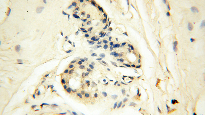 Immunohistochemical of paraffin-embedded human skin using Catalog No:111653(IL1B antibody) at dilution of 1:50 (under 40x lens)