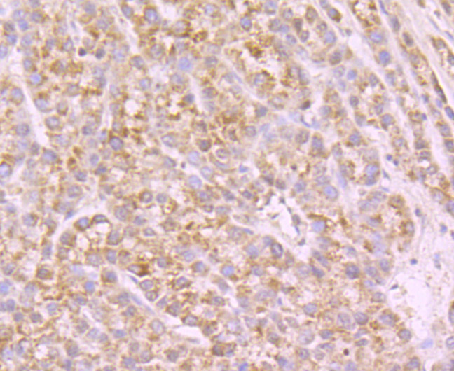 Fig4: Immunohistochemical analysis of paraffin-embedded human liver cancer tissue using anti-NaV1.7 beta antibody. Counter stained with hematoxylin.