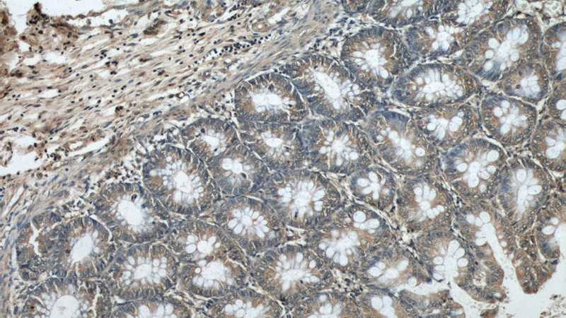Immunohistochemical of paraffin-embedded human colon using Catalog No:108182(ARHGEF1 antibody) at dilution of 1:50 (under 10x lens)