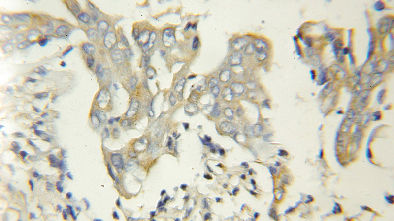 Immunohistochemical of paraffin-embedded human colon cancer using Catalog No:110563(FBXW2 antibody) at dilution of 1:50 (under 10x lens)