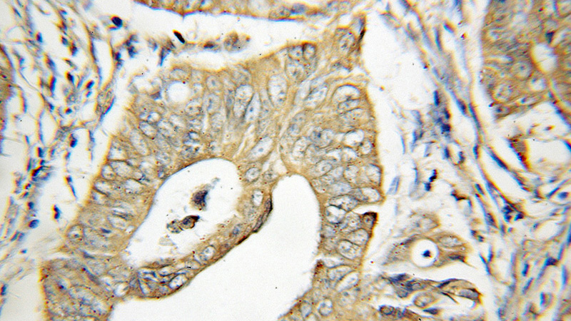 Immunohistochemical of paraffin-embedded human colon cancer using Catalog No:109820(DDX20 antibody) at dilution of 1:100 (under 10x lens)