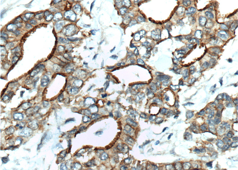 Immunohistochemistry of paraffin-embedded human pancreas cancer tissue slide using Catalog No:111654(IL10 Antibody) at dilution of 1:200 (under 40x lens). heat mediated antigen retrieved with Tris-EDTA buffer(pH9).
