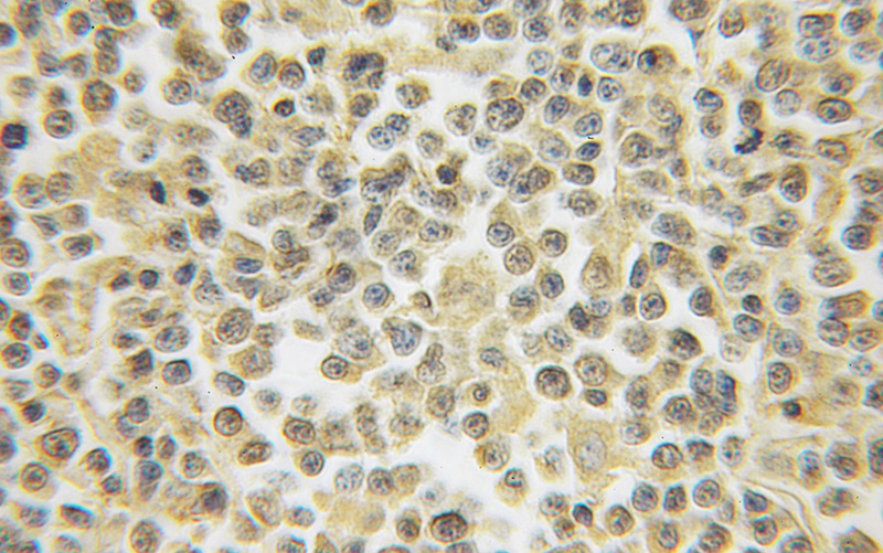 Immunohistochemical of paraffin-embedded human lymphoma using Catalog No:111469(HS2ST1 antibody) at dilution of 1:50 (under 10x lens)