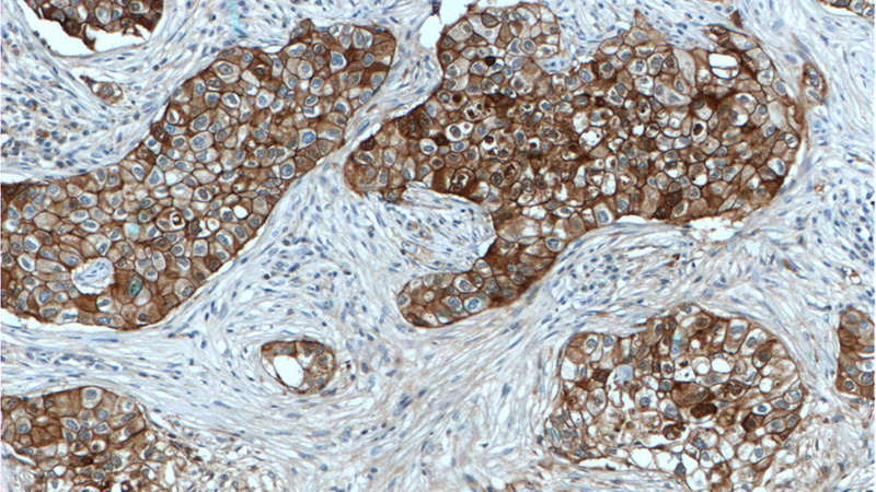 Immunohistochemistry of paraffin-embedded human breast cancer tissue slide using Catalog No:107244(E-cadherin Antibody) at dilution of 1:300 (under 10x lens). Heat mediated antigen retrieved with Tris-EDTA buffer(pH9).