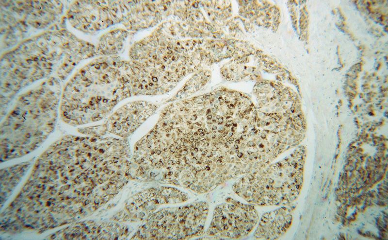 Immunohistochemical of paraffin-embedded human liver cancer using Catalog No:113260(NNT antibody) at dilution of 1:50 (under 10x lens)