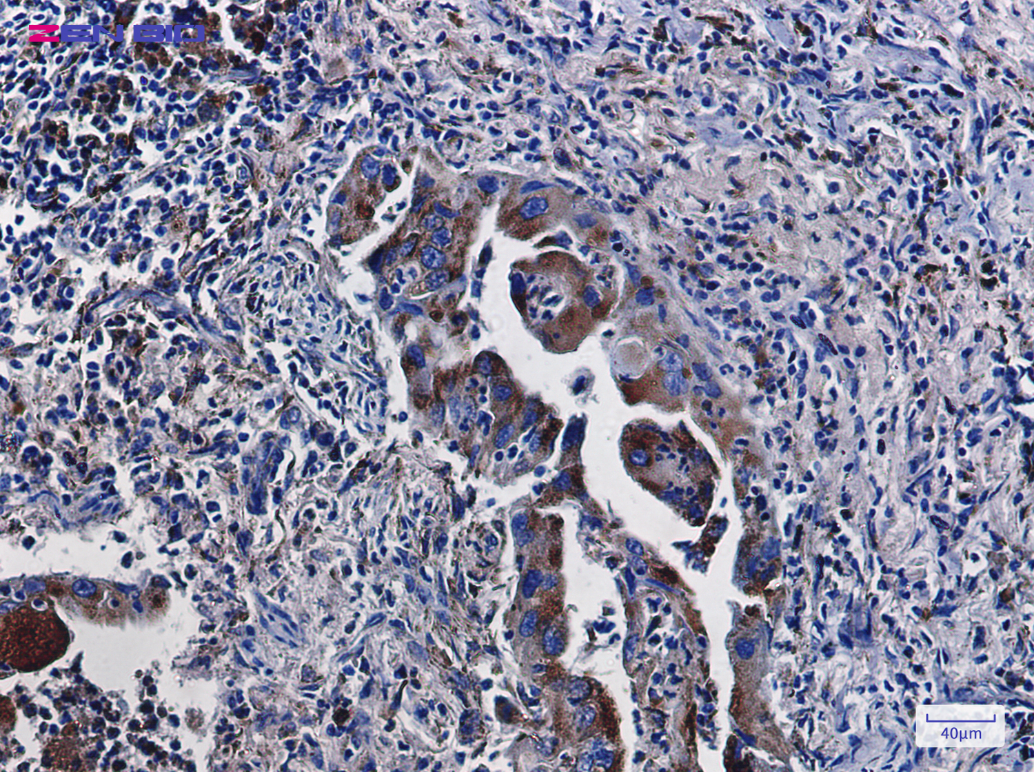 Immunohistochemistry of LAMP2 in paraffin-embedded Human lung cancer tissue using LAMP2 Rabbit pAb at dilution 1/100