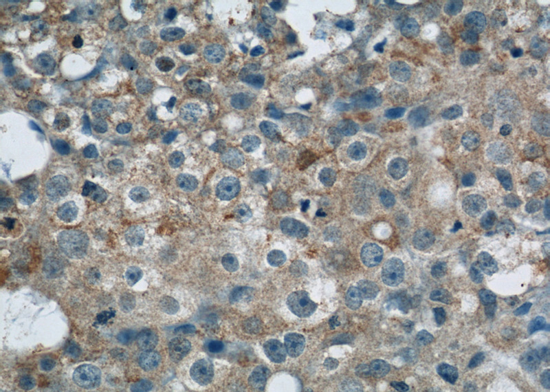 Immunohistochemical of paraffin-embedded human breast cancer using Catalog No:112155(LATH antibody) at dilution of 1:50 (under 40x lens)