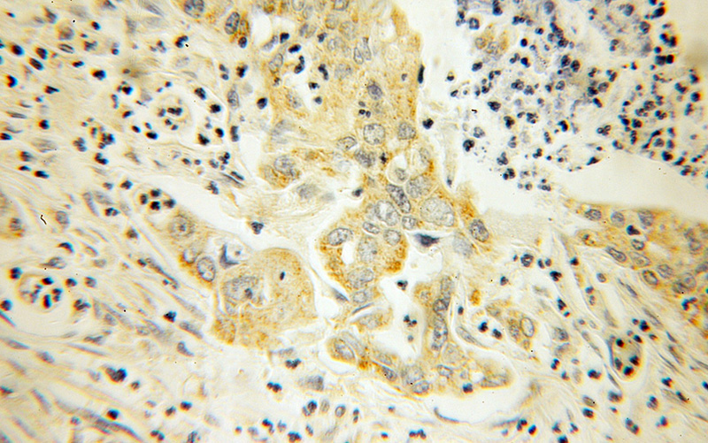 Immunohistochemical of paraffin-embedded human pancreas cancer using Catalog No:116422(TRX2,TXN2 antibody) at dilution of 1:100 (under 10x lens)