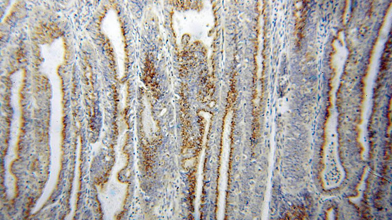 Immunohistochemical of paraffin-embedded human endometrial cancer using Catalog No:116885(YIPF4 antibody) at dilution of 1:50 (under 10x lens)