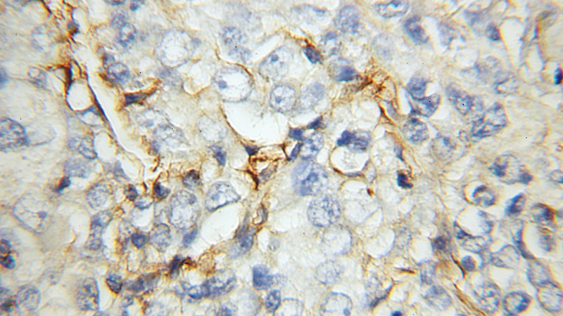 Immunohistochemical of paraffin-embedded human lung cancer using Catalog No:115729(STOM antibody) at dilution of 1:100 (under 10x lens)