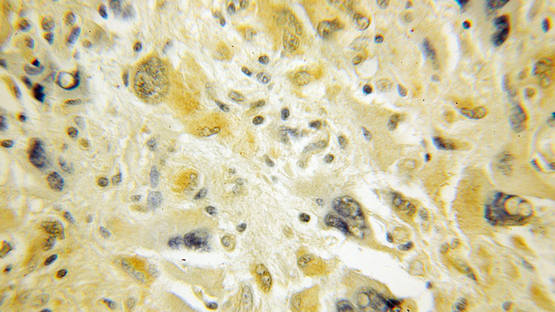 Immunohistochemical of paraffin-embedded human medulloblastoma using Catalog No:115337(SLC25A46 antibody) at dilution of 1:50 (under 10x lens)