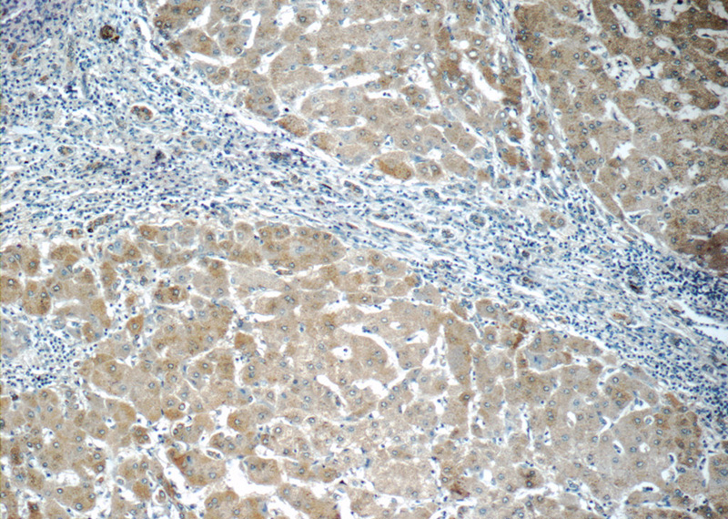 Immunohistochemistry of paraffin-embedded human hepatocirrhosis tissue slide using Catalog No:112732(RAGE Antibody) at dilution of 1:50 (under 10x lens)