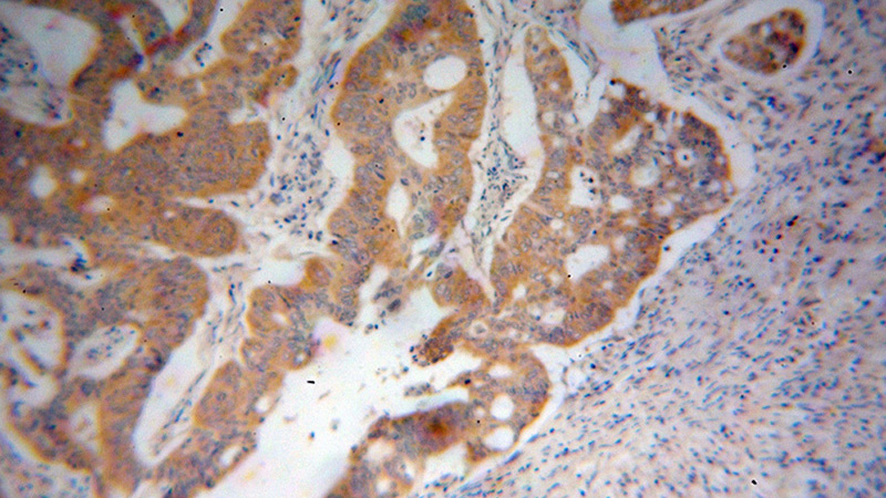 Immunohistochemical of paraffin-embedded human colon cancer using Catalog No:116570(UMPS antibody) at dilution of 1:100 (under 10x lens)