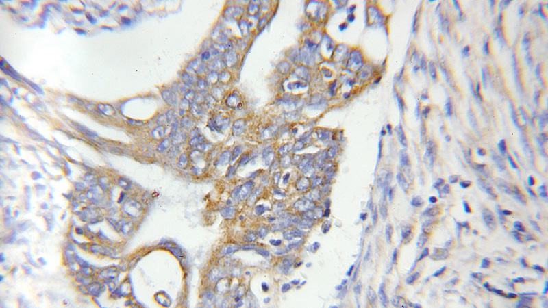 Immunohistochemical of paraffin-embedded human colon cancer using Catalog No:109272(CHPF antibody) at dilution of 1:50 (under 10x lens)