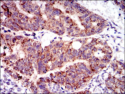 Immunohistochemical analysis of paraffin-embedded rectum cancer tissues using SHP-2 mouse mAb with DAB staining.