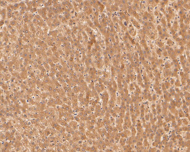 Fig2:; Immunohistochemical analysis of paraffin-embedded human liver tissue using anti-Alpha-2-macroglobulin antibody. The section was pre-treated using heat mediated antigen retrieval with Tris-EDTA buffer (pH 8.0-8.4) for 20 minutes.The tissues were blocked in 5% BSA for 30 minutes at room temperature, washed with ddH; 2; O and PBS, and then probed with the primary antibody ( 1/400) for 30 minutes at room temperature. The detection was performed using an HRP conjugated compact polymer system. DAB was used as the chromogen. Tissues were counterstained with hematoxylin and mounted with DPX.