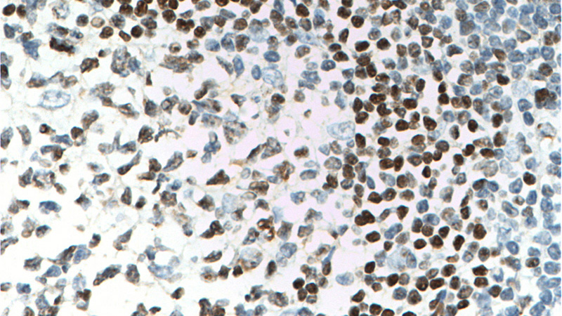 Immunohistochemistry of paraffin-embedded human tonsillitis tissue slide using Catalog No:117248(BSAP,PAX5 Antibody) at dilution of 1:100 (under 40x lens). heat mediated antigen retrieved with Sodium Citrate buffer (pH6).