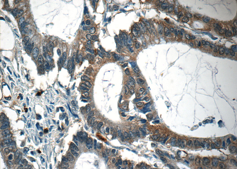 Immunohistochemistry of paraffin-embedded human colon cancer tissue slide using Catalog No:108844(CAPZA1 Antibody) at dilution of 1:50 (under 40x lens)