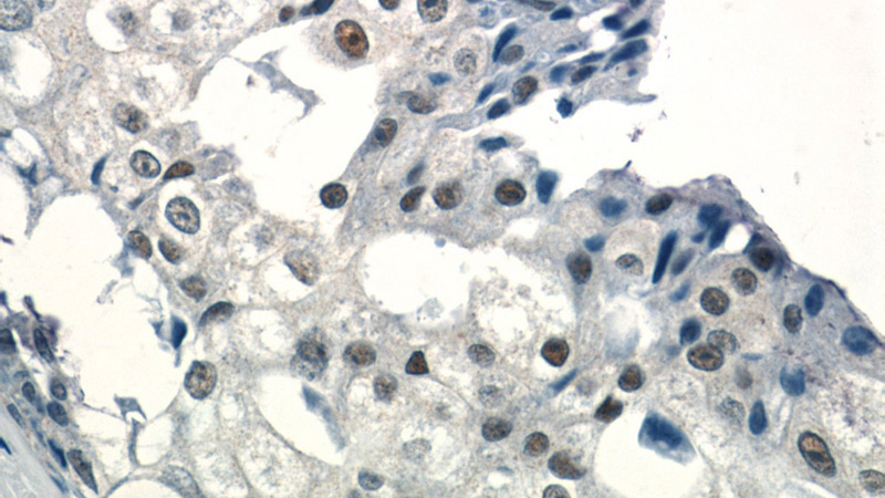 Immunohistochemistry of paraffin-embedded human breast cancer tissue slide using Catalog No:110170(EID1 Antibody) at dilution of 1:50 (under 40x lens)