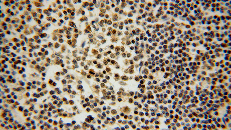 Immunohistochemical of paraffin-embedded human lymphoma using Catalog No:110088(DNAJB1 antibody) at dilution of 1:100 (under 40x lens)