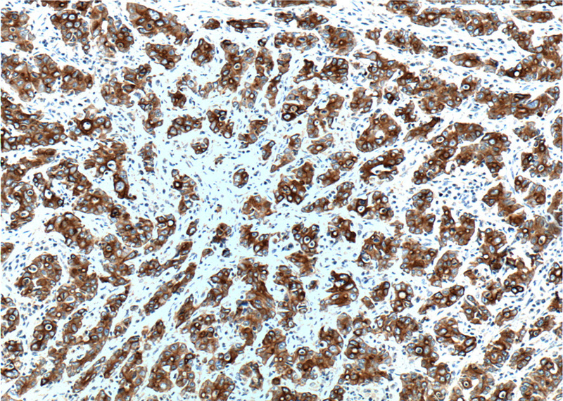 Immunohistochemistry of paraffin-embedded human stomach cancer tissue slide using Catalog No:107232(KRT19 Antibody) at dilution of 1:200 (under 10x lens). heat mediated antigen retrieved with Tris-EDTA buffer(pH9).