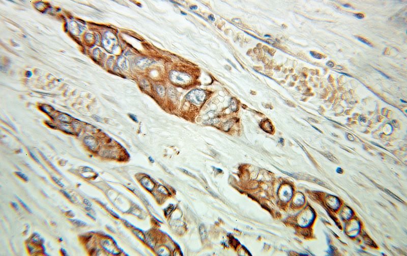 Immunohistochemical of paraffin-embedded human ovary tumor using Catalog No:114442(RAB3C antibody) at dilution of 1:100 (under 10x lens)