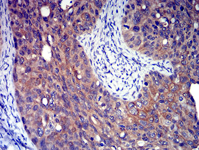 Fig4: Immunohistochemical analysis of paraffin-embedded cervical cancer tissue using anti-P2RY8 antibody. The section was pre-treated using heat mediated antigen retrieval with Tris-EDTA buffer (pH 8.0) for 20 minutes. The tissues were blocked in 5% BSA for 30 minutes at room temperature, washed with ddH2O and PBS, and then probed with the primary antibody ( 1/100) for 30 minutes at room temperature. The detection was performed using an HRP conjugated compact polymer system. DAB was used as the chromogen. Tissues were counterstained with hematoxylin and mounted with DPX.