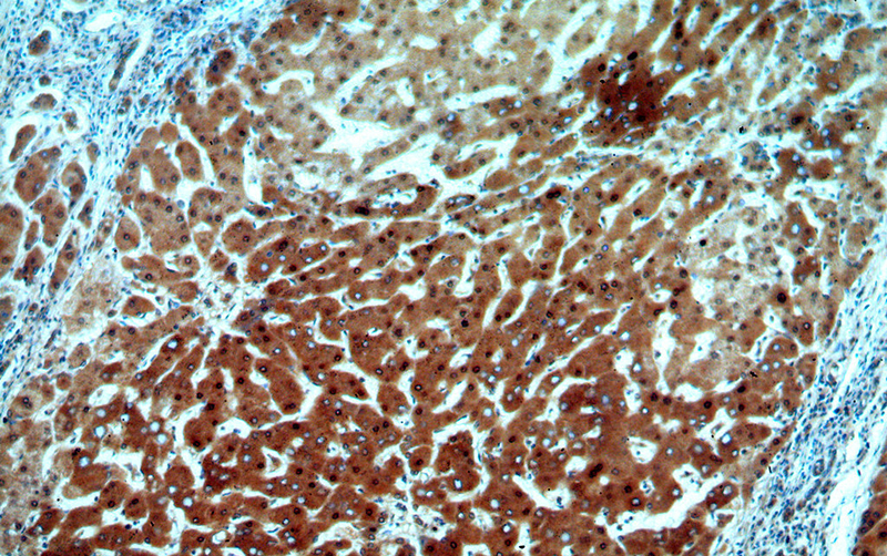 Immunohistochemical of paraffin-embedded human hepatocirrhosis using Catalog No:107777(ADAT2 antibody) at dilution of 1:50 (under 10x lens)