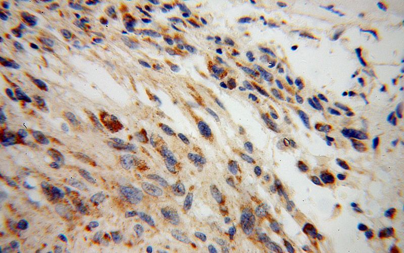 Immunohistochemical of paraffin-embedded human gliomas using Catalog No:109868(DARS2 antibody) at dilution of 1:100 (under 40x lens)