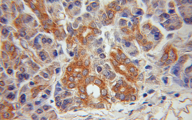 Immunohistochemical of paraffin-embedded human pancreas cancer using Catalog No:111897(Jph2 antibody) at dilution of 1:50 (under 10x lens)