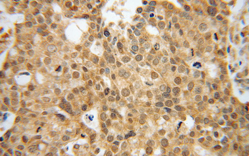 Immunohistochemical of paraffin-embedded human ovary tumor using Catalog No:110311(EEF1A2 antibody) at dilution of 1:100 (under 40x lens)