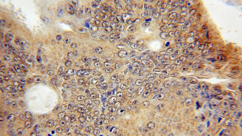 Immunohistochemical of paraffin-embedded human colon cancer using Catalog No:109451(Connexin-26 antibody) at dilution of 1:50 (under 10x lens)