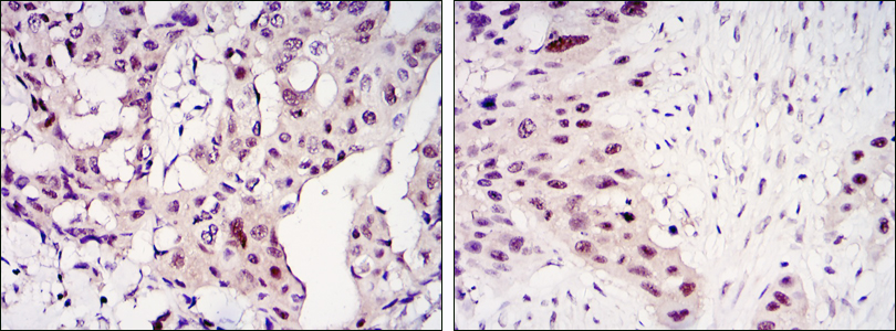 Immunohistochemical analysis of paraffin-embedded mammary cancer tissues (left) and lung cancer tissues (right) using STAT3 mouse mAb with DAB staining.