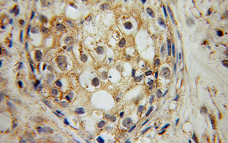 Immunohistochemical of paraffin-embedded human breast cancer using Catalog No:114534(RAMP2 antibody) at dilution of 1:100 (under 10x lens)