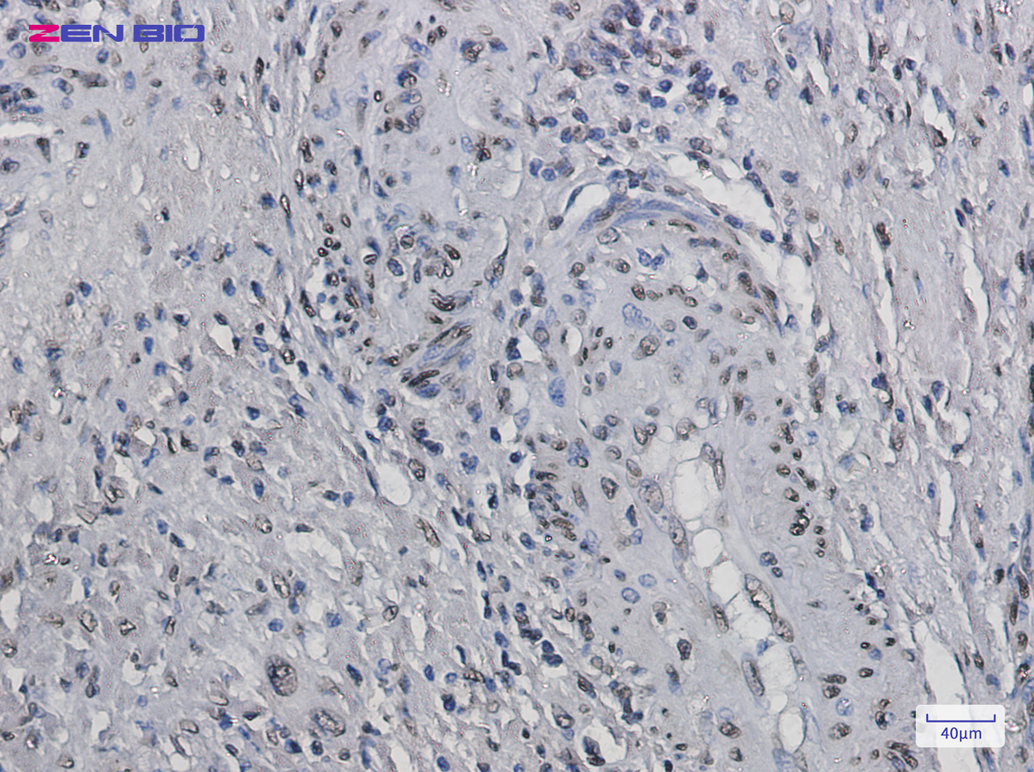 Immunohistochemistry of Histone H2B in paraffin-embedded Human colon cancer tissue using Histone H2B Rabbit pAb at dilution 1/20