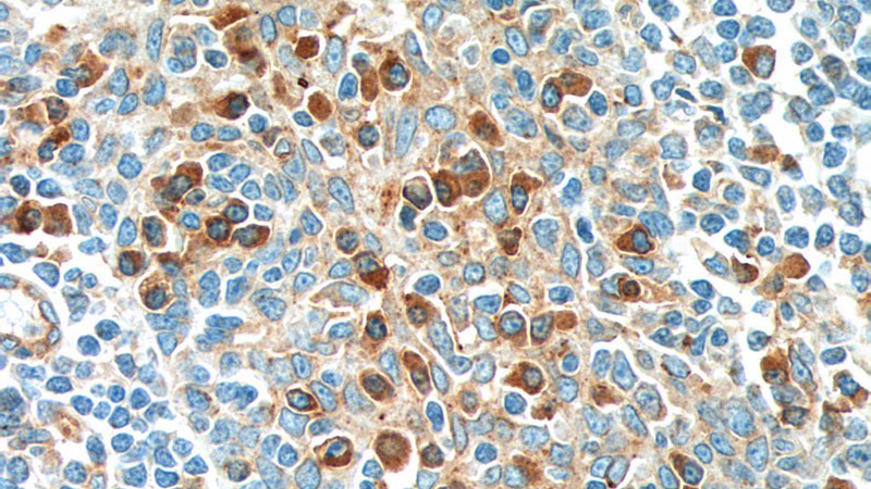 Immunohistochemistry of paraffin-embedded human tonsillitis tissue slide using Catalog No:107390(IL2 Antibody) at dilution of 1:800 (under 40x lens). Heat mediated antigen retrieved with Tris-EDTA buffer, pH9.0