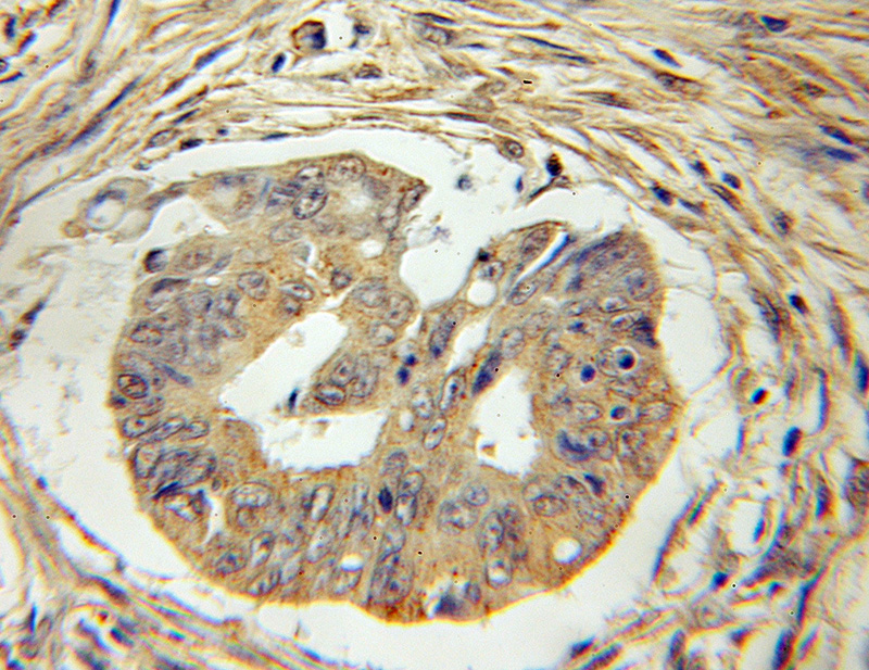 Immunohistochemical of paraffin-embedded human colon cancer using Catalog No:116131(TIMM17A antibody) at dilution of 1:100 (under 10x lens)