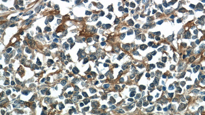 Immunohistochemistry of paraffin-embedded human lymphoma tissue slide using Catalog No:113783(PGD Antibody) at dilution of 1:50 (under 40x lens)
