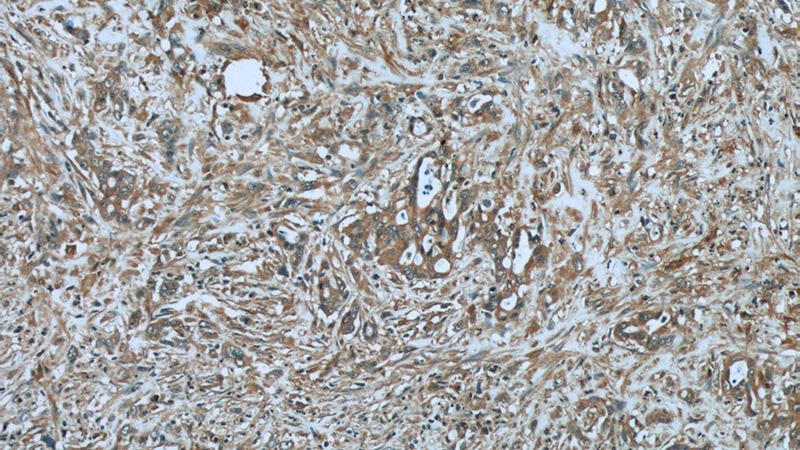 Immunohistochemistry of paraffin-embedded human stomach cancer tissue slide using Catalog No:107234(KRT8 Antibody) at dilution of 1:50 (under 10x lens)