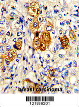 Formalin-fixed and paraffin-embedded human breast carcinoma with C5 Antibody (N-term), which was peroxidase-conjugated to the secondary antibody, followed by DAB staining. This data demonstrates the use of this antibody for immunohistochemistry; clinical