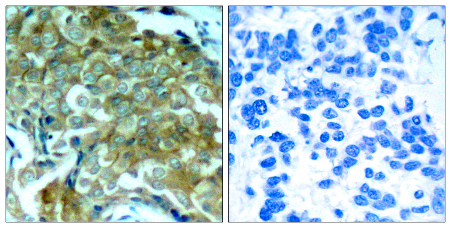Immunohistochemical analysis of paraffin-embedded human breast carcinoma tissue using EGFR (Phospho-Tyr1172) Antibody (left) or the same antibody preincubated with blocking peptide (right).