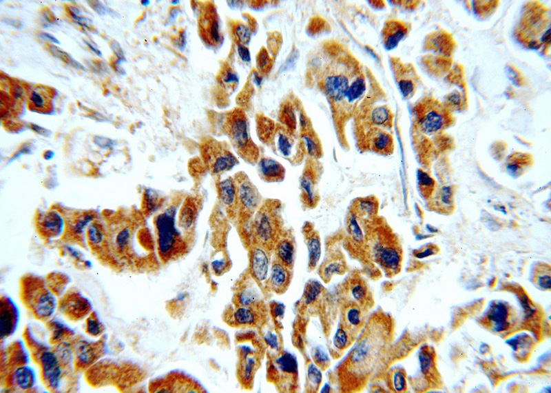 Immunohistochemical of paraffin-embedded human breast cancer using Catalog No:116020(TGFB2-Specific antibody) at dilution of 1:100 (under 40x lens)