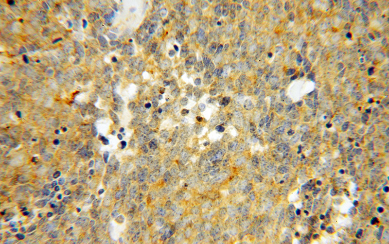 Immunohistochemical of paraffin-embedded human lung cancer using Catalog No:115810(STXBP2 antibody) at dilution of 1:100 (under 40x lens)