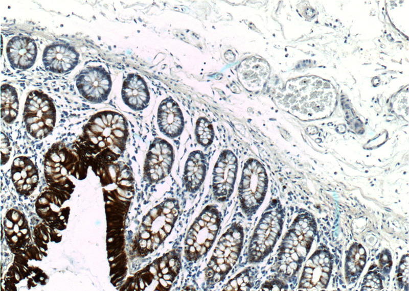 Immunohistochemistry of paraffin-embedded human colon tissue slide using Catalog No:109803(CK19-specific Antibody) at dilution of 1:200 (under 10x lens)