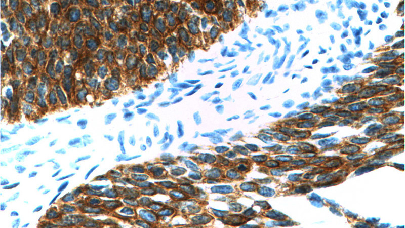 Immunohistochemistry of paraffin-embedded human cervical cancer tissue slide using Catalog No:109795(KRT16 Antibody) at dilution of 1:200 (under 40x lens)