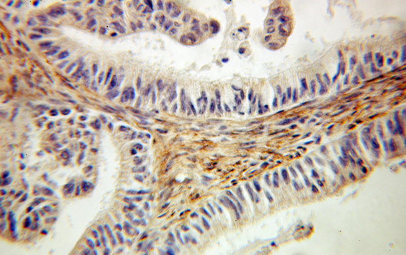Immunohistochemical of paraffin-embedded human ovary tumor using Catalog No:110239(EMILIN1 antibody) at dilution of 1:100 (under 10x lens)