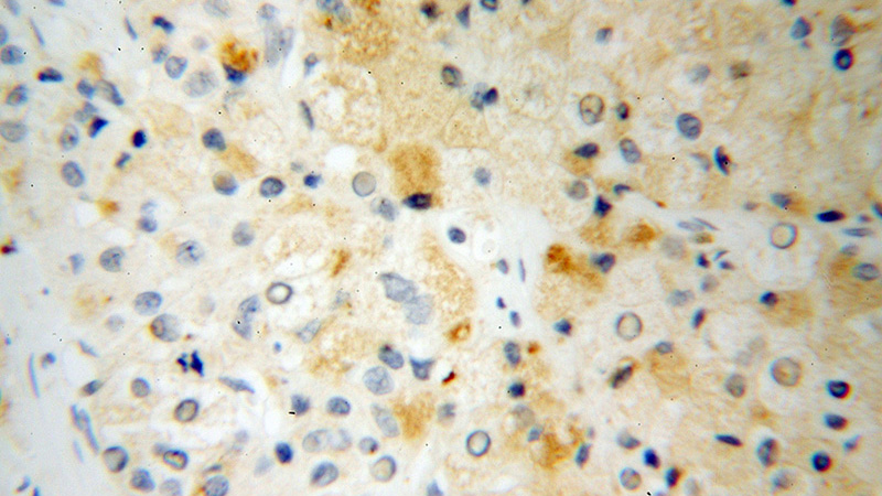 Immunohistochemical of paraffin-embedded human liver cancer using Catalog No:112599(MGLL antibody) at dilution of 1:100 (under 40x lens)